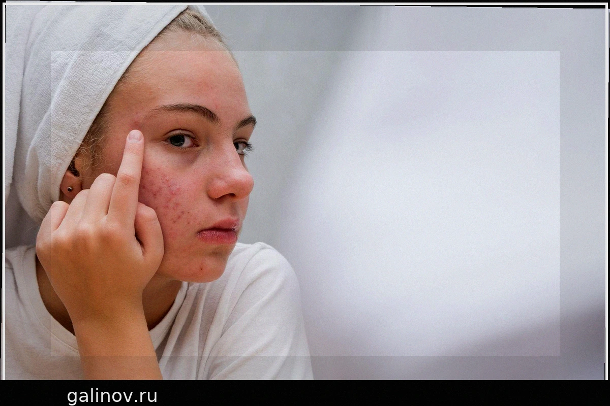 Простой уход за кожей для подростков: советы дерматологов
